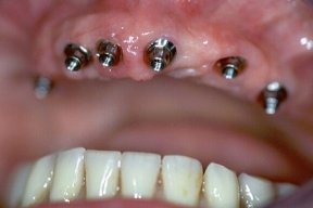 Implantate im Mund
