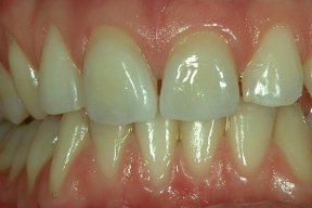 Veneers auf Zahn 11+ 21